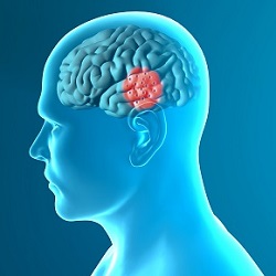 Introduction to Parkinson's Disease Image